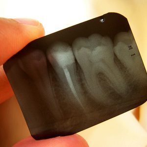 An X-ray of teeth being held between a thumb and forefinger.