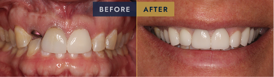 Before & After