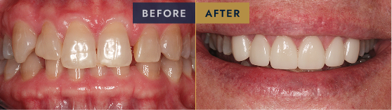 Before & After