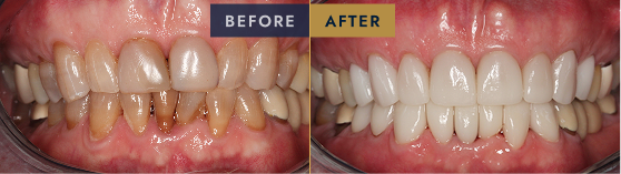 Before & After