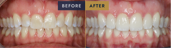 Before & After